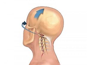 As the osteochondrose of the spine of cervix manifests